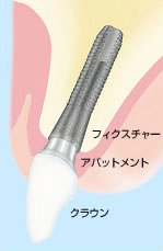 歯科インプラント