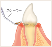 歯垢・歯石の除去